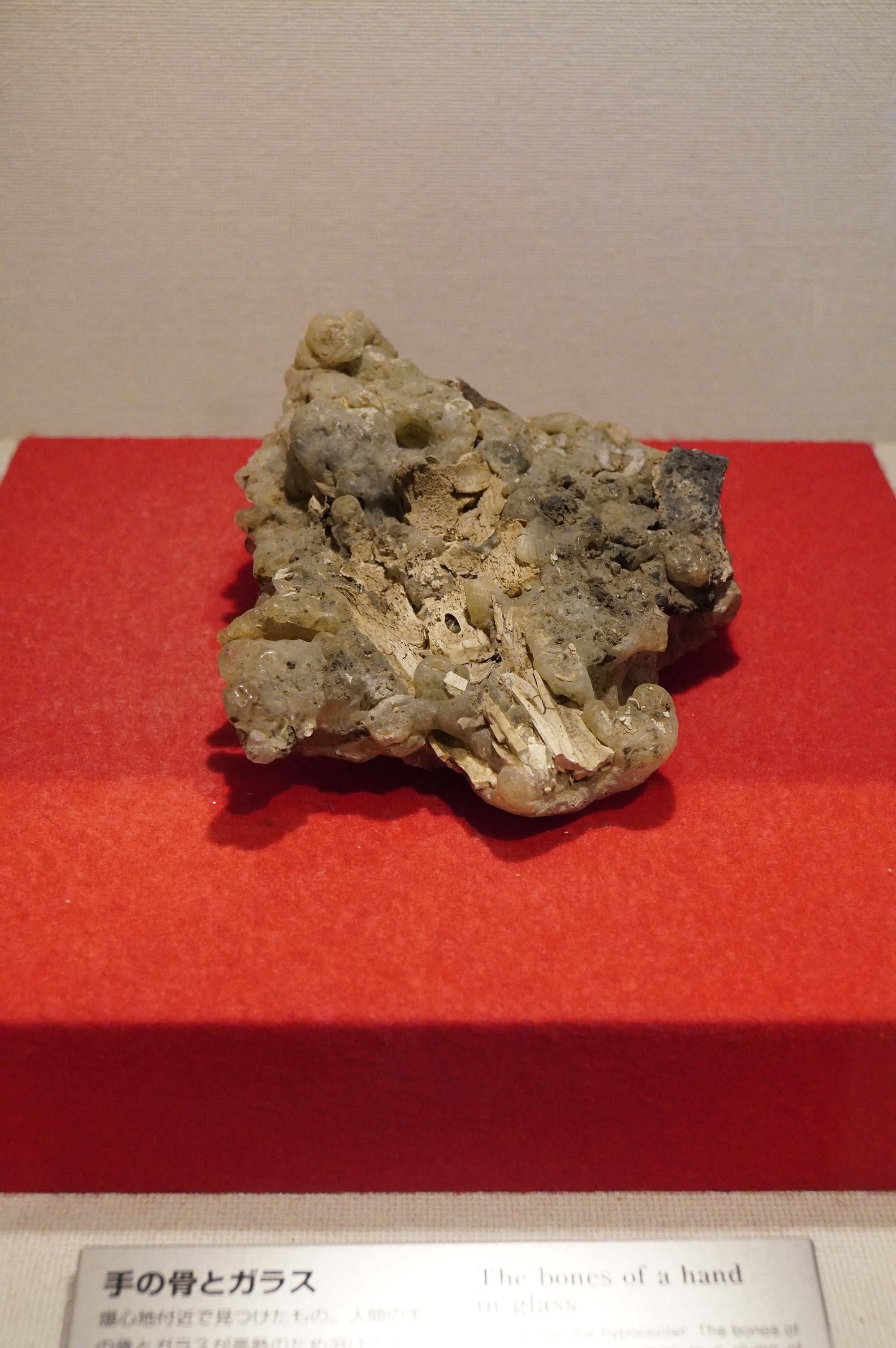 menschliche Handknochen in Glas eingeschmolzen